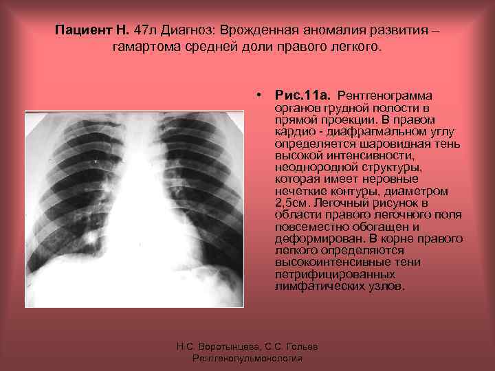 Пациент Н. 47 л Диагноз: Врожденная аномалия развития – гамартома средней доли правого легкого.