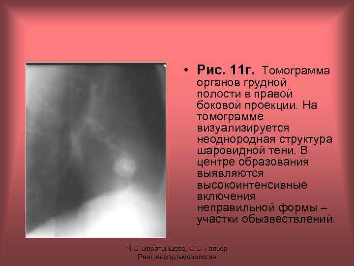  • Рис. 11 г. Томограмма органов грудной полости в правой боковой проекции. На