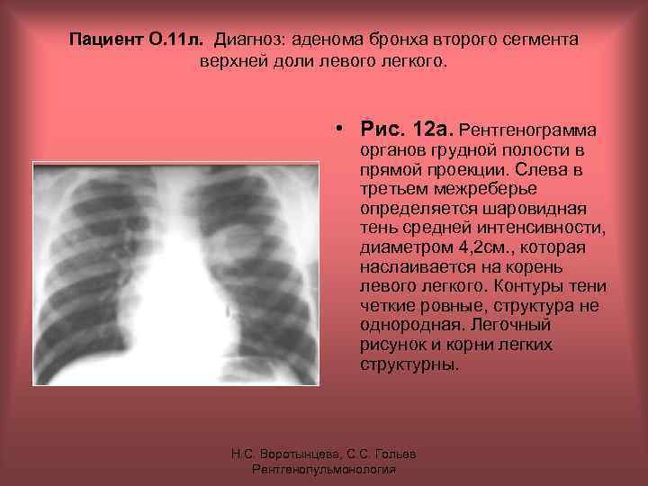 Пациент О. 11 л. Диагноз: аденома бронха второго сегмента верхней доли левого легкого. •