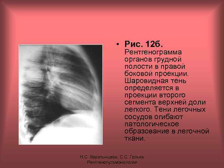  • Рис. 12 б. Рентгенограмма органов грудной полости в правой боковой проекции. Шаровидная