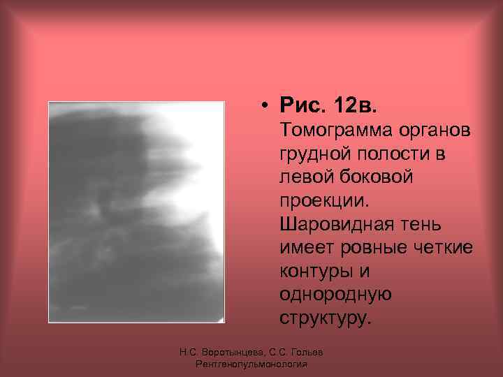  • Рис. 12 в. Томограмма органов грудной полости в левой боковой проекции. Шаровидная