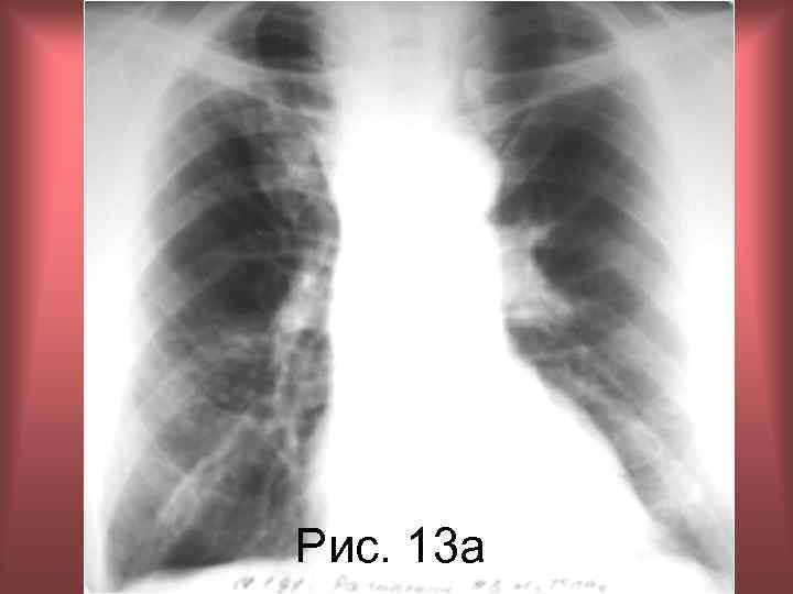 Рис. 13 а Н. С. Воротынцева, С. С. Гольев Рентгенопульмонология 