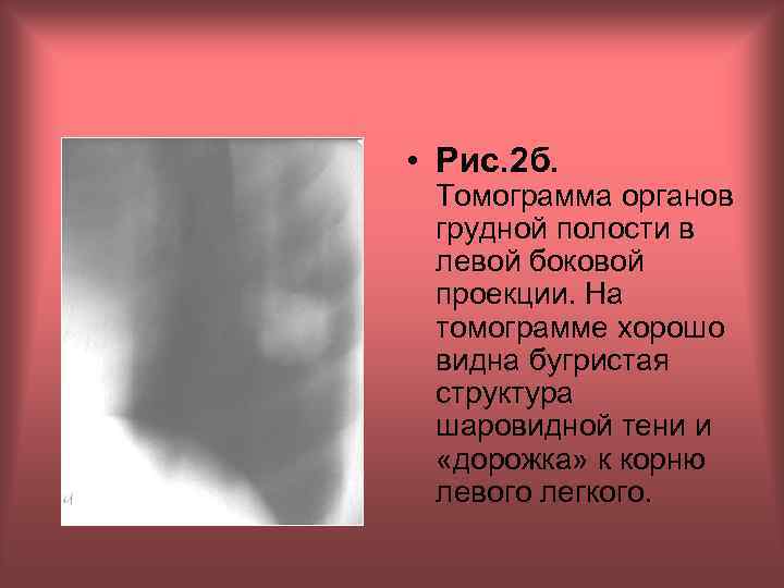  • Рис. 2 б. Томограмма органов грудной полости в левой боковой проекции. На
