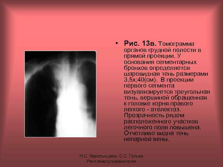  • Рис. 13 в. Томограмма органов грудной полости в прямой проекции. У основания