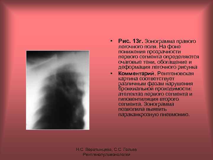  • Рис. 13 г. Зонограмма правого • легочного поля. На фоне понижения прозрачности