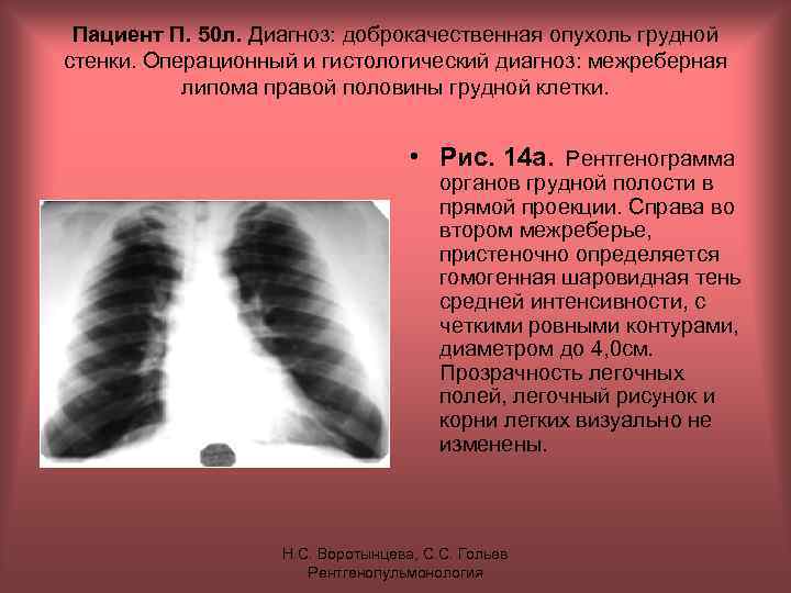 Пациент П. 50 л. Диагноз: доброкачественная опухоль грудной стенки. Операционный и гистологический диагноз: межреберная