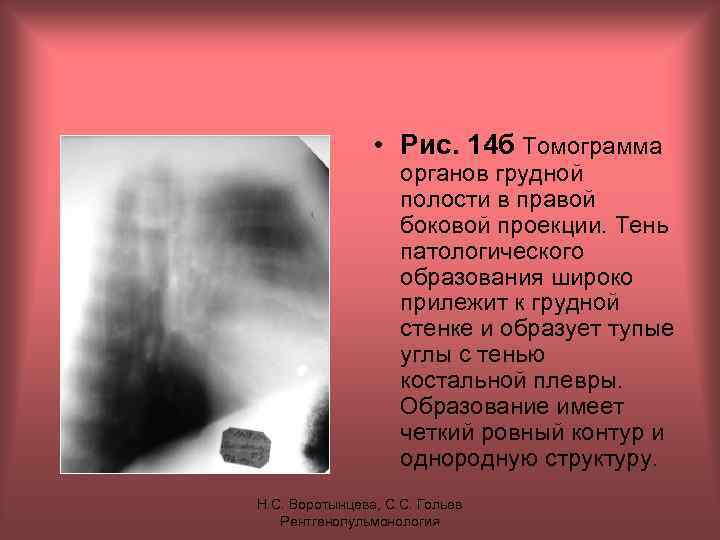  • Рис. 14 б Томограмма органов грудной полости в правой боковой проекции. Тень