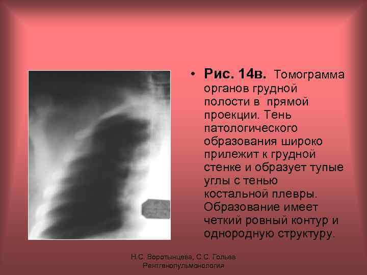  • Рис. 14 в. Томограмма органов грудной полости в прямой проекции. Тень патологического