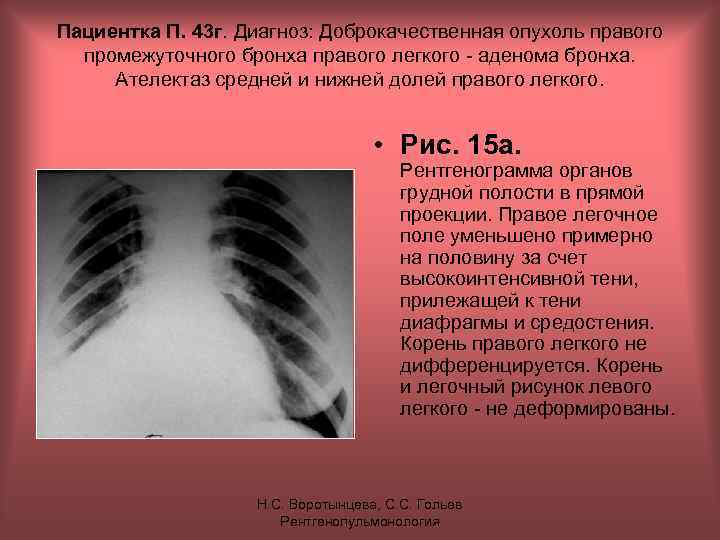 Пациентка П. 43 г. Диагноз: Доброкачественная опухоль правого промежуточного бронха правого легкого - аденома