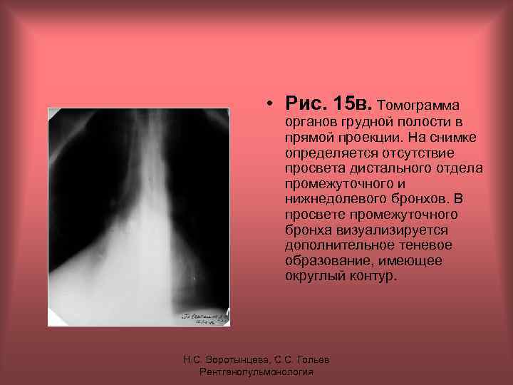  • Рис. 15 в. Томограмма органов грудной полости в прямой проекции. На снимке