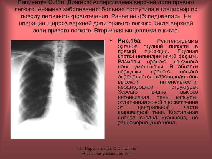 Пациентка С. 48 л. Диагноз: Аспергиллема верхней доли правого легкого. Анамнез заболевания: больная поступила