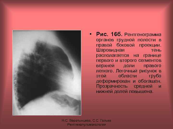  • Рис. 16 б. Рентгенограмма органов грудной полости в правой боковой проекции. Шаровидная