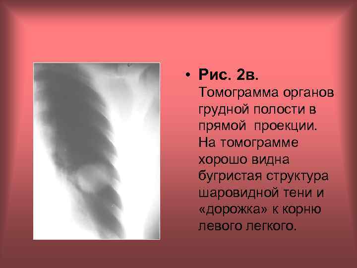  • Рис. 2 в. Томограмма органов грудной полости в прямой проекции. На томограмме