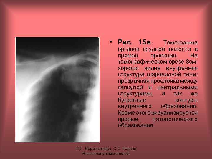  • Рис. 15 в. Томограмма органов грудной полости в прямой проекции. На томографическом