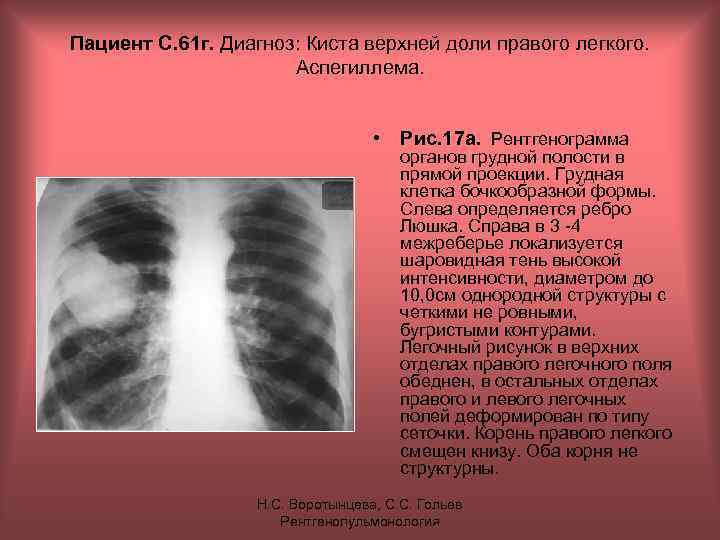 Пациент С. 61 г. Диагноз: Киста верхней доли правого легкого. Аспегиллема. • Рис. 17