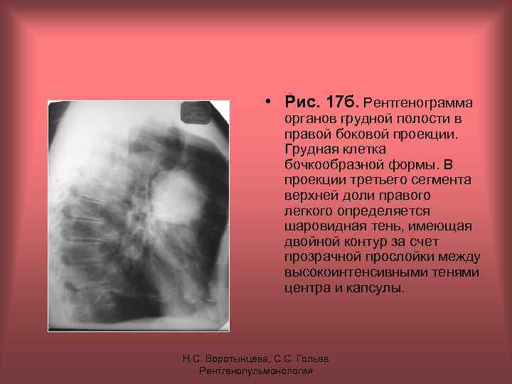  • Рис. 17 б. Рентгенограмма органов грудной полости в правой боковой проекции. Грудная