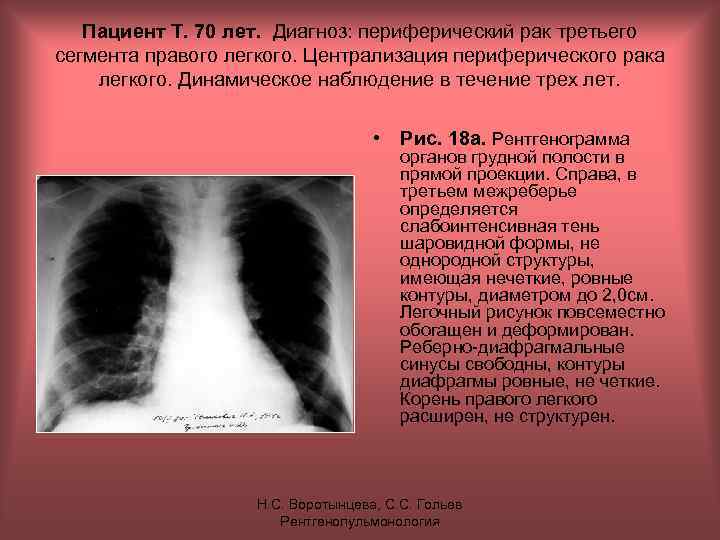 Пациент Т. 70 лет. Диагноз: периферический рак третьего сегмента правого легкого. Централизация периферического рака