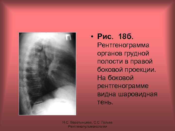  • Рис. 18 б. Рентгенограмма органов грудной полости в правой боковой проекции. На