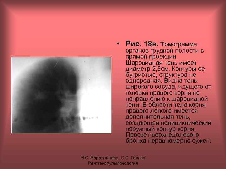 • Рис. 18 в. Томограмма органов грудной полости в прямой проекции. Шаровидная тень