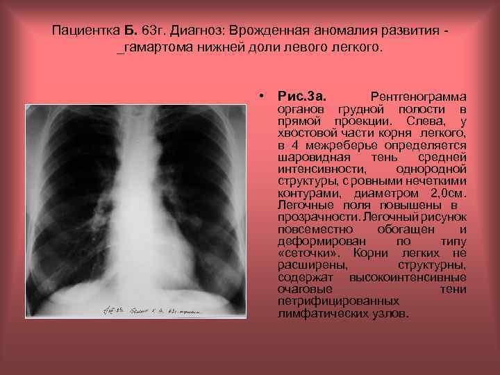 Пациентка Б. 63 г. Диагноз: Врожденная аномалия развития _гамартома нижней доли левого легкого. •