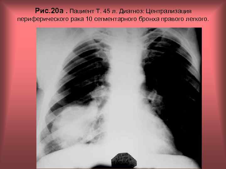Рис. 20 а. Пациент Т. 45 л. Диагноз: Централизация периферического рака 10 сегментарного бронха