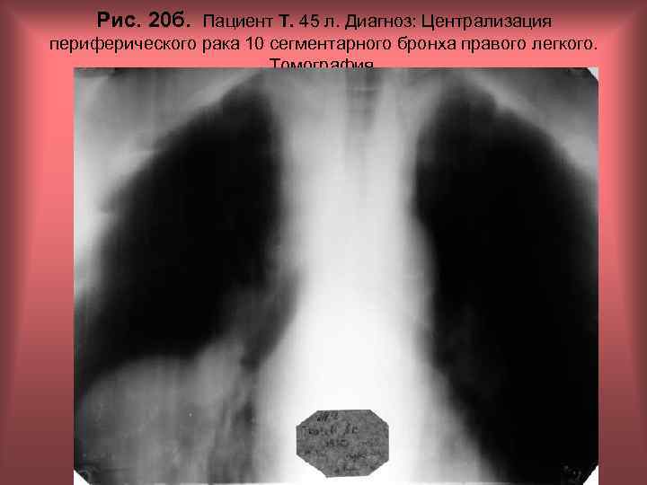 Рис. 20 б. Пациент Т. 45 л. Диагноз: Централизация периферического рака 10 сегментарного бронха