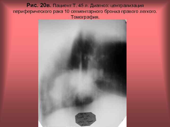 Рис. 20 в. Пациент Т. 45 л. Диагноз: централизация периферического рака 10 сегментарного бронха