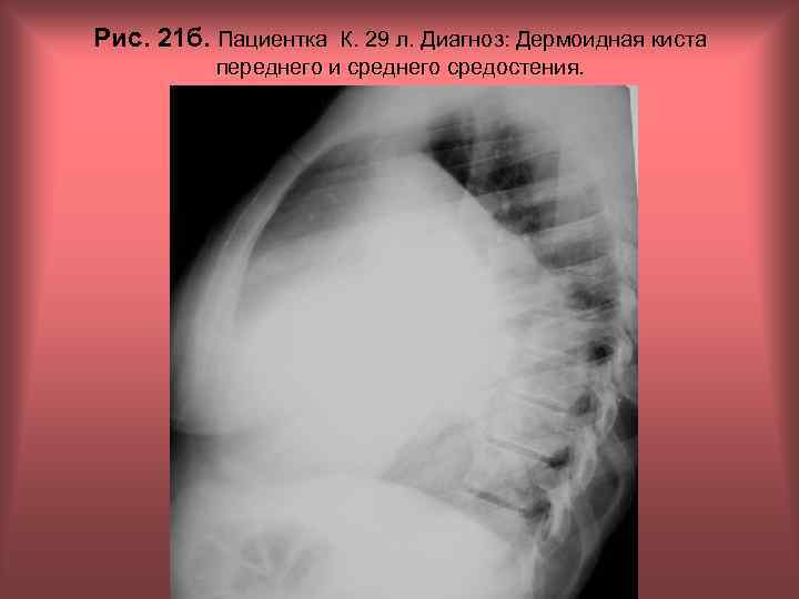 Рис. 21 б. Пациентка К. 29 л. Диагноз: Дермоидная киста переднего и среднего средостения.