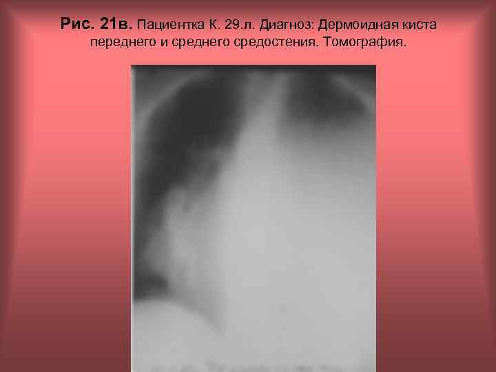 Рис. 21 в. Пациентка К. 29. л. Диагноз: Дермоидная киста переднего и среднего средостения.