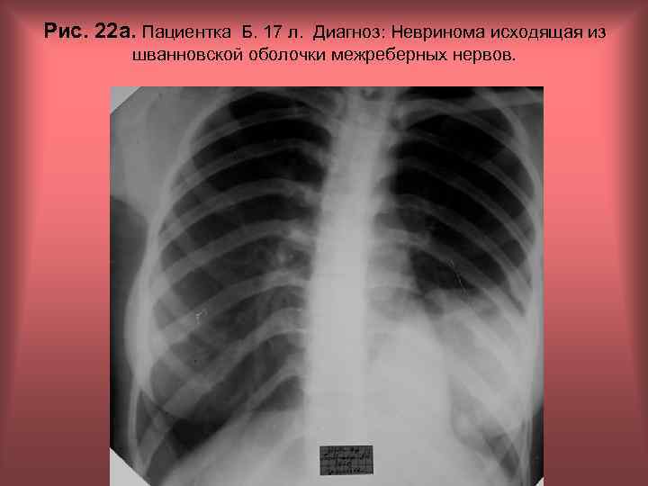 Рис. 22 а. Пациентка Б. 17 л. Диагноз: Невринома исходящая из шванновской оболочки межреберных
