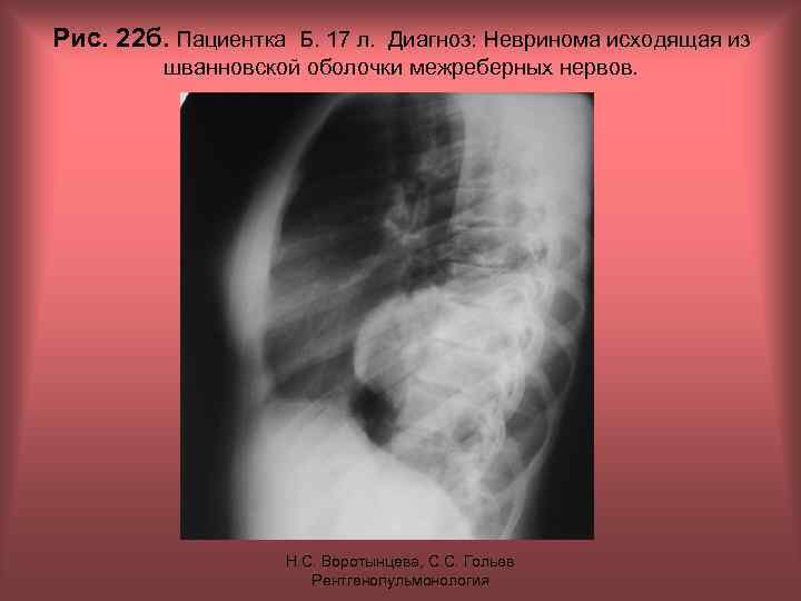 Рис. 22 б. Пациентка Б. 17 л. Диагноз: Невринома исходящая из шванновской оболочки межреберных