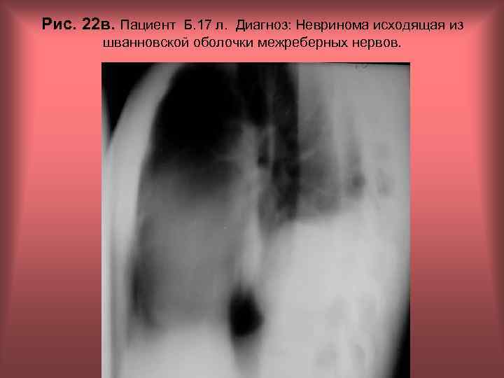 Рис. 22 в. Пациент Б. 17 л. Диагноз: Невринома исходящая из шванновской оболочки межреберных