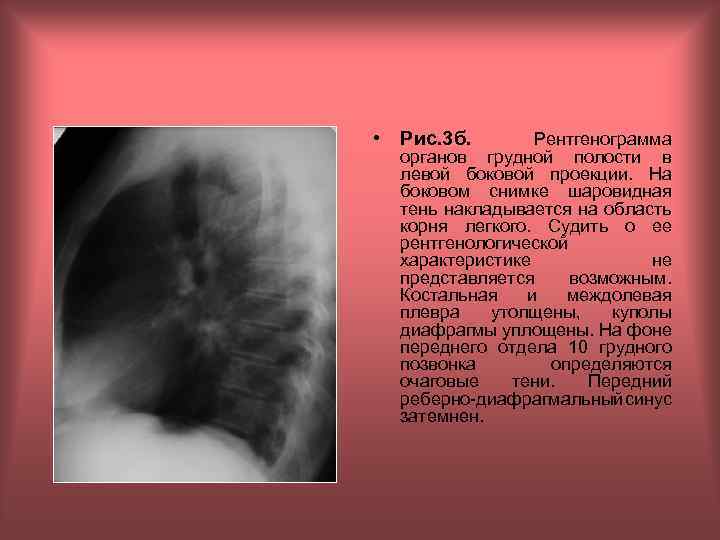  • Рис. 3 б. Рентгенограмма органов грудной полости в левой боковой проекции. На