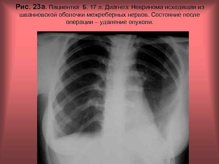 Рис. 23 а. Пациентка Б. 17 л. Диагноз: Невринома исходящая из шванновской оболочки межреберных