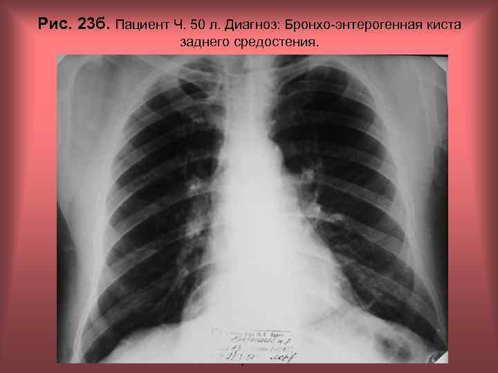 Рис. 23 б. Пациент Ч. 50 л. Диагноз: Бронхо-энтерогенная киста заднего средостения. Н. С.