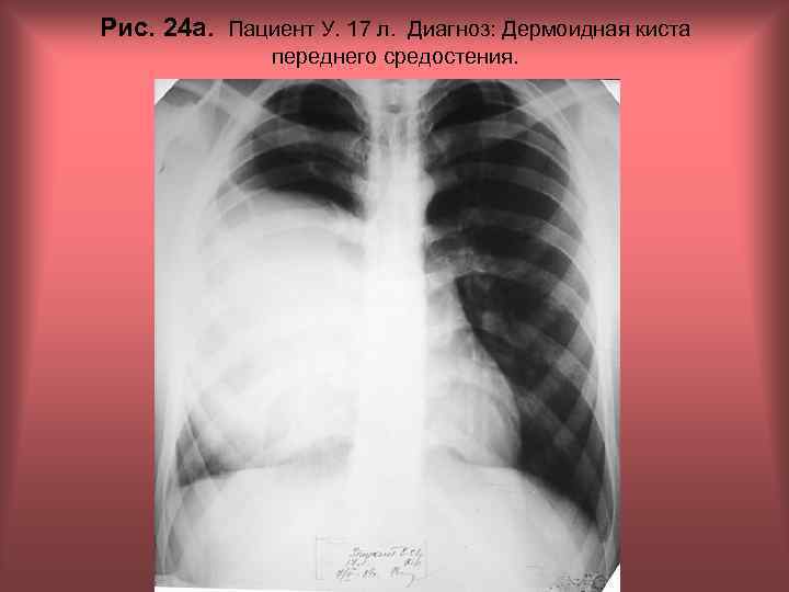 Рис. 24 а. Пациент У. 17 л. Диагноз: Дермоидная киста переднего средостения. Н. С.