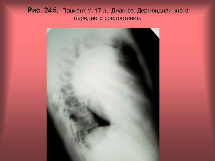 Рис. 24 б. Пациент У. 17 л. Диагноз: Дермоидная киста переднего средостения. Н. С.