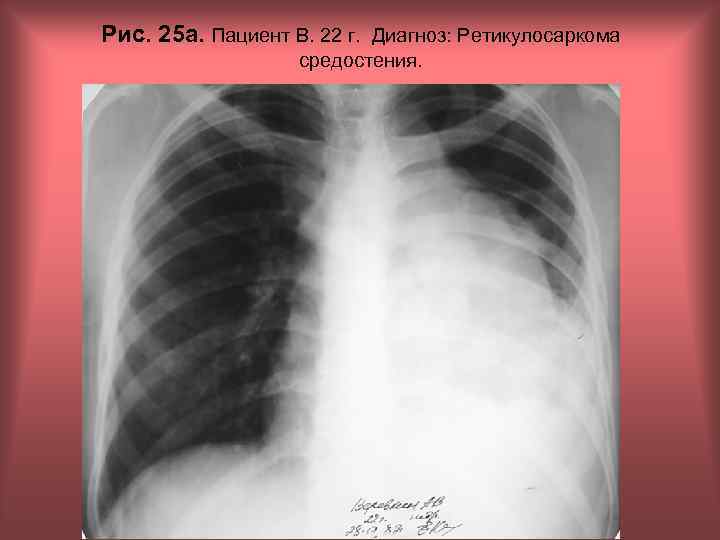 Рис. 25 а. Пациент В. 22 г. Диагноз: Ретикулосаркома средостения. Н. С. Воротынцева, С.