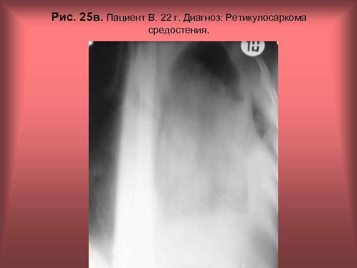Рис. 25 в. Пациент В. 22 г. Диагноз: Ретикулосаркома средостения. Н. С. Воротынцева, С.