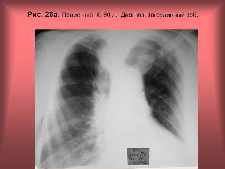 Рис. 26 а. Пациентка К. 80 л. Диагноз: загрудинный зоб. Н. С. Воротынцева, С.