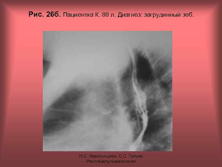 Рис. 26 б. Пациентка К. 80 л. Диагноз: загрудинный зоб. Н. С. Воротынцева, С.