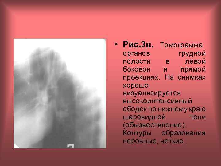  • Рис. 3 в. Томограмма органов грудной полости в левой боковой и прямой