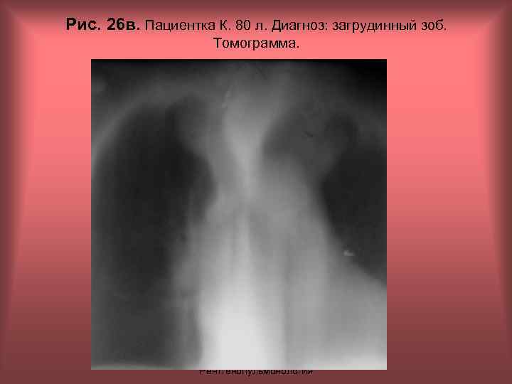 Рис. 26 в. Пациентка К. 80 л. Диагноз: загрудинный зоб. Томограмма. Н. С. Воротынцева,