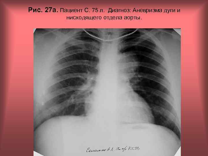 Рис. 27 а. Пациент С. 75 л. Диагноз: Аневризма дуги и нисходящего отдела аорты.