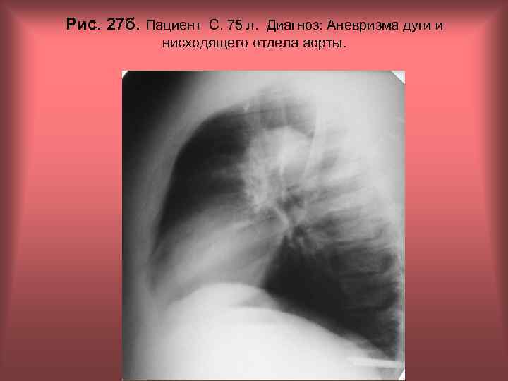 Рис. 27 б. Пациент С. 75 л. Диагноз: Аневризма дуги и нисходящего отдела аорты.