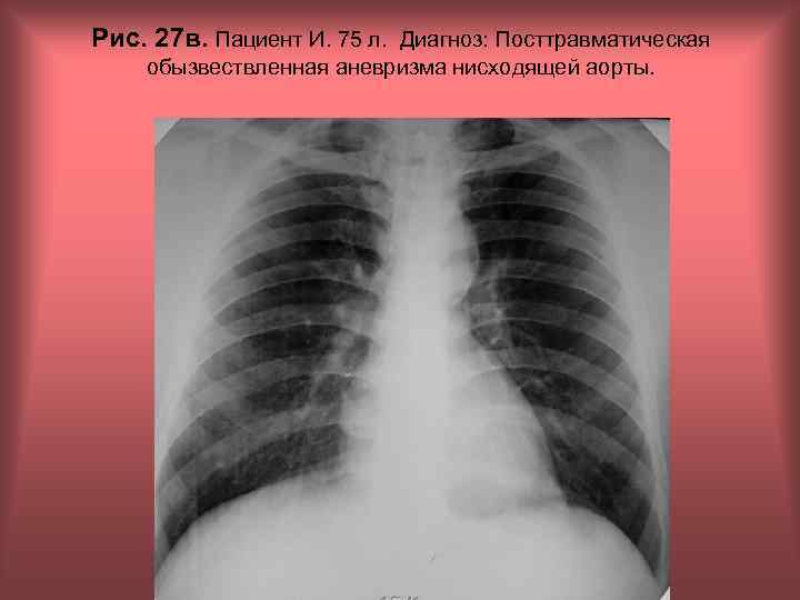 Рис. 27 в. Пациент И. 75 л. Диагноз: Посттравматическая обызвествленная аневризма нисходящей аорты. Н.