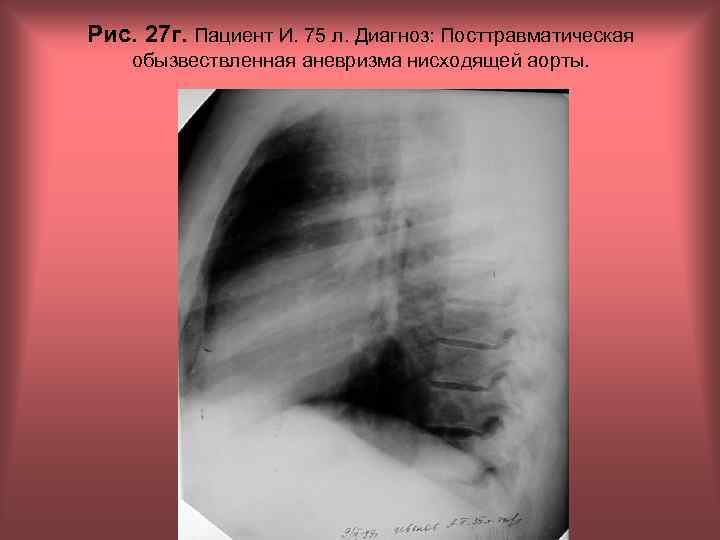 Рис. 27 г. Пациент И. 75 л. Диагноз: Посттравматическая обызвествленная аневризма нисходящей аорты. Н.
