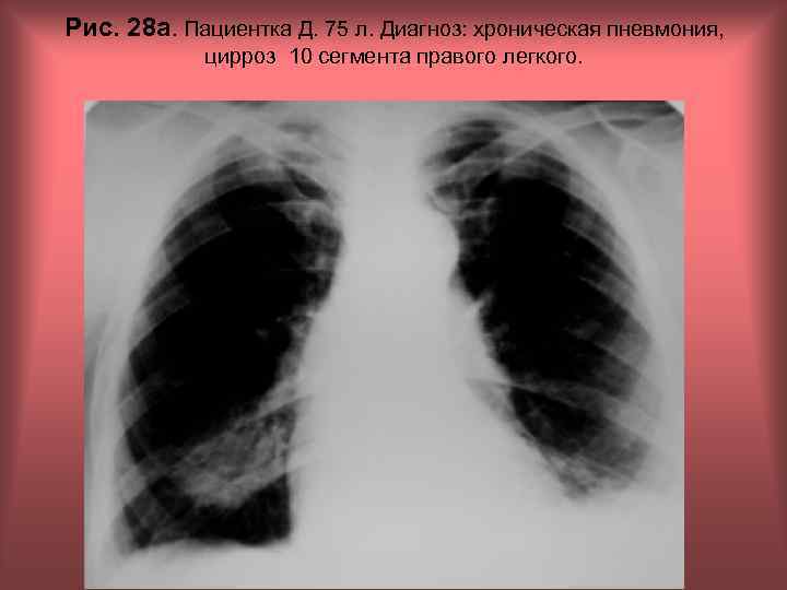 Рис. 28 а. Пациентка Д. 75 л. Диагноз: хроническая пневмония, цирроз 10 сегмента правого