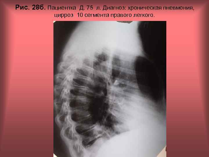 Рис. 28 б. Пациентка Д. 75 л. Диагноз: хроническая пневмония, цирроз 10 сегмента правого