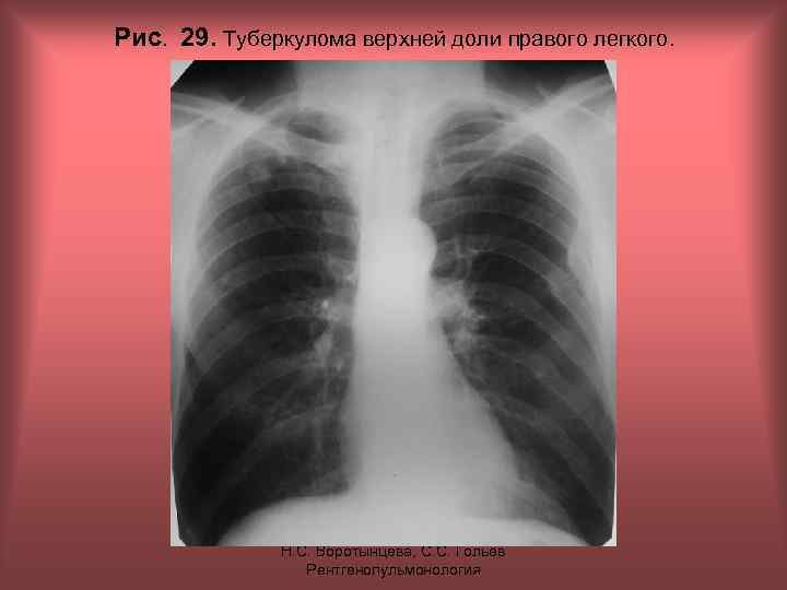 Рис. 29. Туберкулома верхней доли правого легкого. Н. С. Воротынцева, С. С. Гольев Рентгенопульмонология
